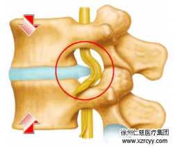 【脊柱】腰突不看年齡，生活習(xí)慣是關(guān)鍵！