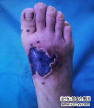 長了“刺瘊子”怎么辦？輕信“偏方”不僅治不了病，可能還會害了你
