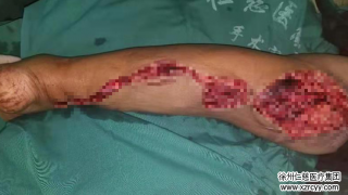 車禍傷后10小時，奔波500里，原本要截肢的腿在這保住了！