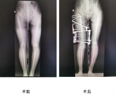 花季少女跛行15年，仁慈骨科利用Ilizarov技術(shù)幫其健康行走