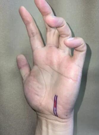 騎行60公里，她“累”到捏不起筷子 | 這是神經(jīng)損傷，可能需手術(shù)！